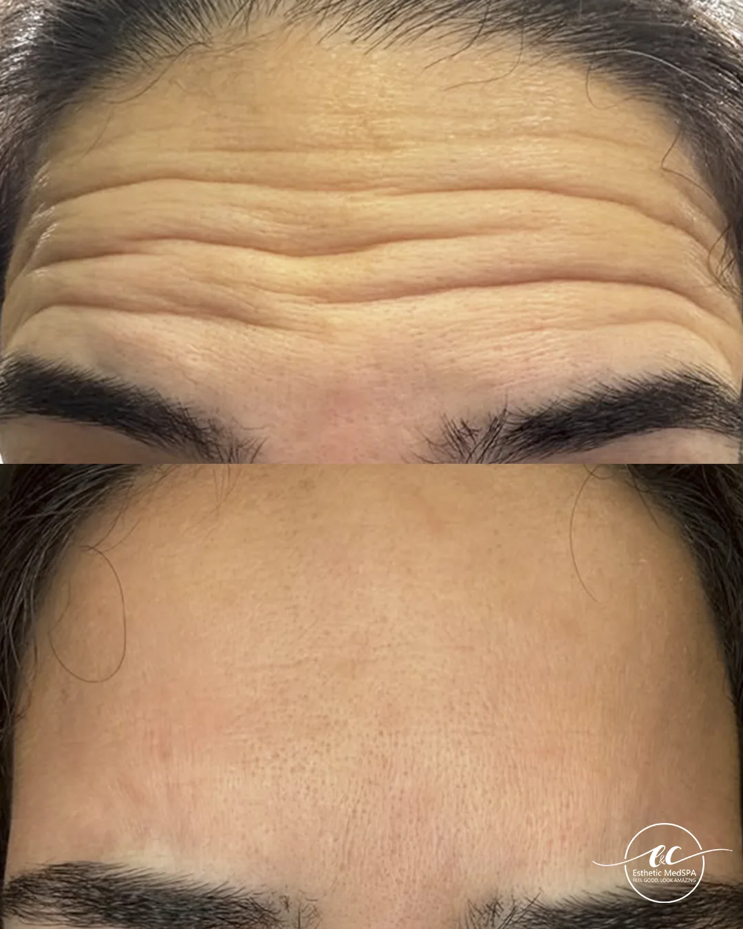 Neuromodulator before and after result