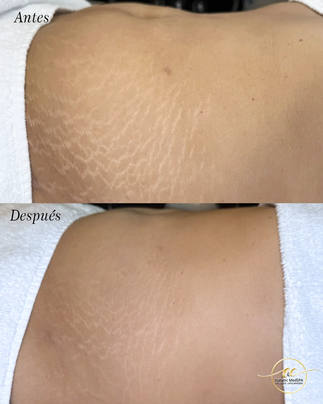 CO2 laser before and after result