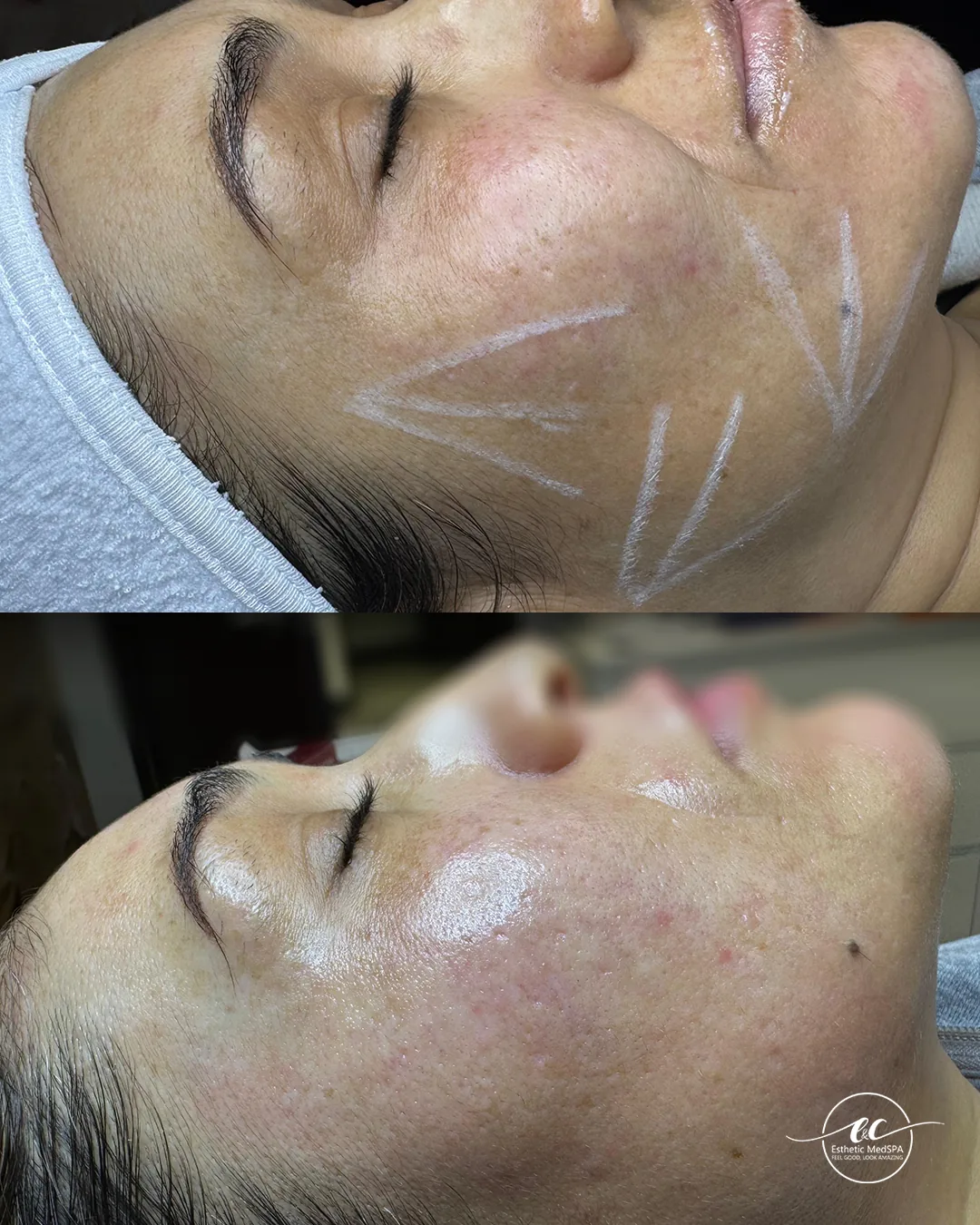 Sculptra before and after result