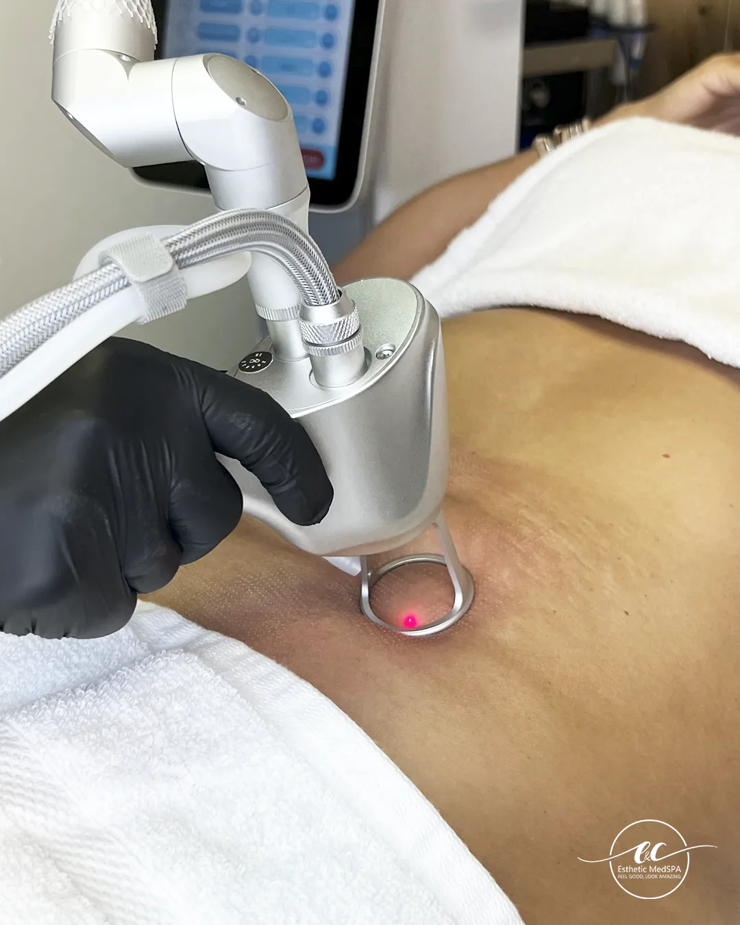 CO2 laser skin rejuvenation